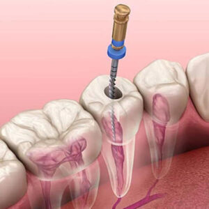 microscopic-root-canal-treatment