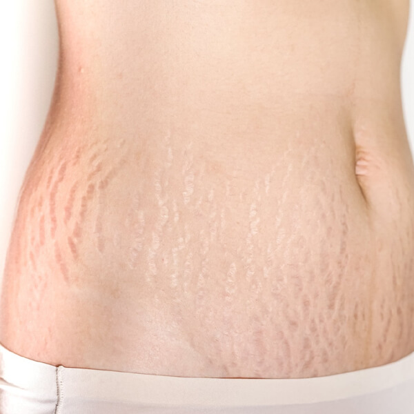 Stretch-Mark-Reduction