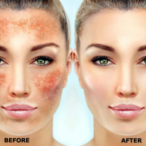 anti-pigmentation-treatment