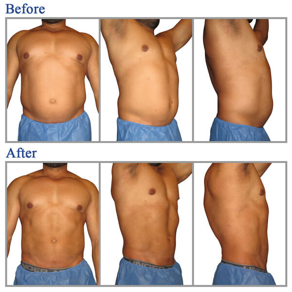 liposuction